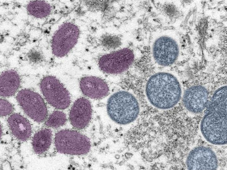 Mpox: symptoms to look out for and how dangerous it is as first case of deadly Clade 1b strain found in the UK