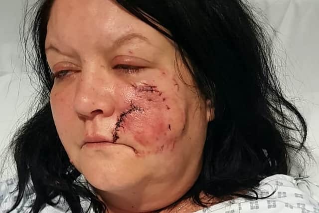 Rachel says she still “cries” whenever she hears a dog growl. Pictured are facial injuries she sustained in the attack.