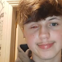 Mother's warning after teenager loses eye when firework 'exploded in his face'