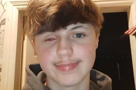 Teenager Aleks Stasiukiewicz, from Hartlepool, lost his left eye in a tragic firework-related accident 