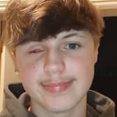 Teenager Aleks Stasiukiewicz, from Hartlepool, lost his left eye in a tragic firework-related accident