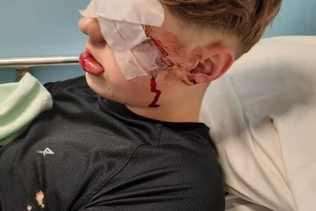 Aleks Stasiukiewicz after the firework accident in November 2024.