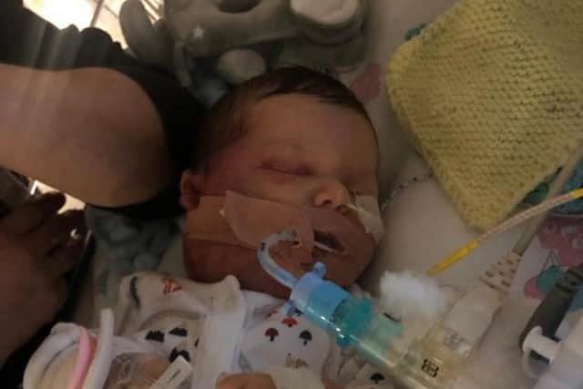 Newborn Ralph Gibbs, from Baildon, was born with a lump on his neck which turned out to be a rare benign tumour of blood vessels.