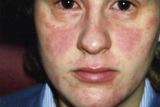 Suzanne's eczema was really bad in her teens and affected her self-esteem