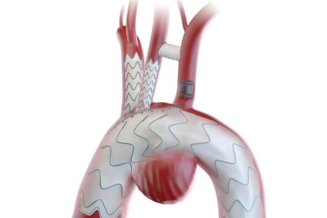 Relay Branch Aorta with device bypass tunnels