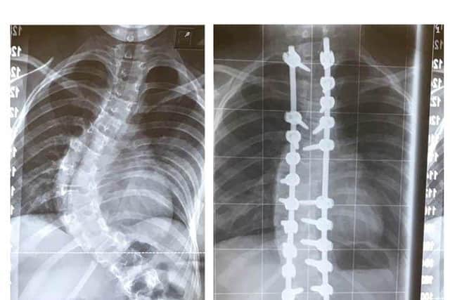 Ruby's spine was twsited into a 'S' shape and surgeons spent nine hours straightening it