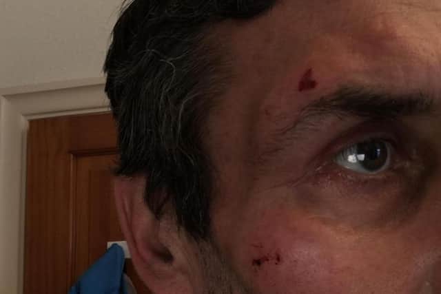 Lorry driver Dave Green's injuries after he was hit in the face with a brick deliberately thrown at his vehicle.