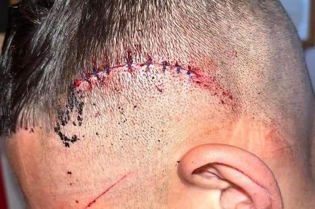 The victim needed stitches
