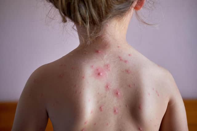 A chickenpox rash