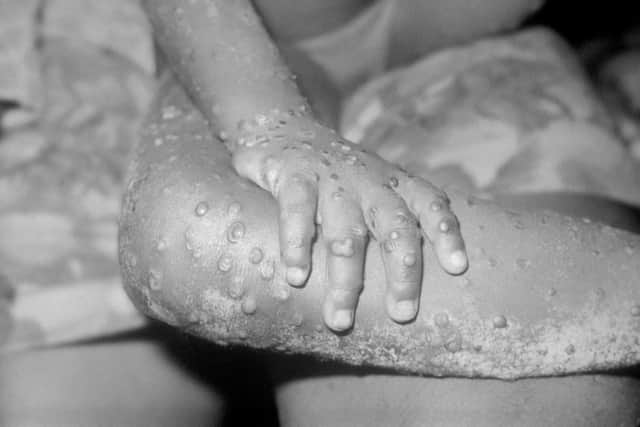 A monkeypox rash