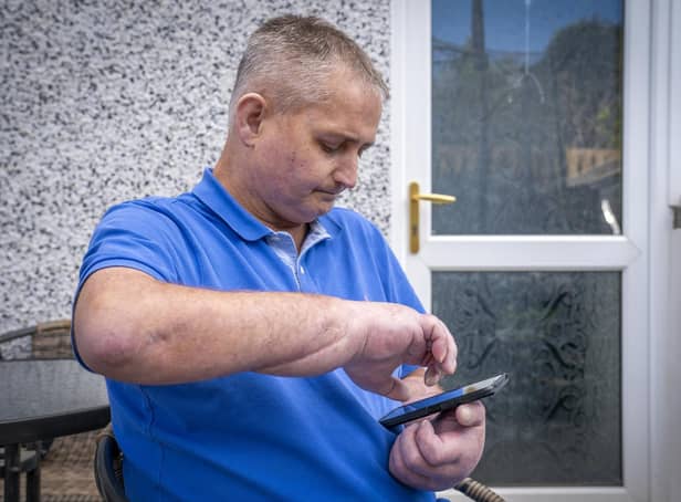 Steven Gallagher, from Dreghorn, Ayrshire, is the first person in the world to have a double hand transplant after suffering from the rare disease scleroderma