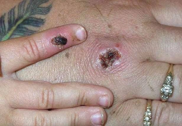 Whilst the numbers remain relatively small at the moment, the spread of monleypox is causing health specialist some concern. Getty
