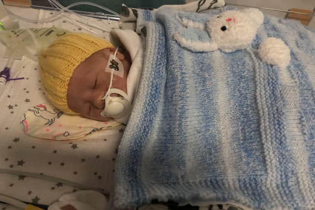 Alfie had to have emergency surgery just a few hours after he was born