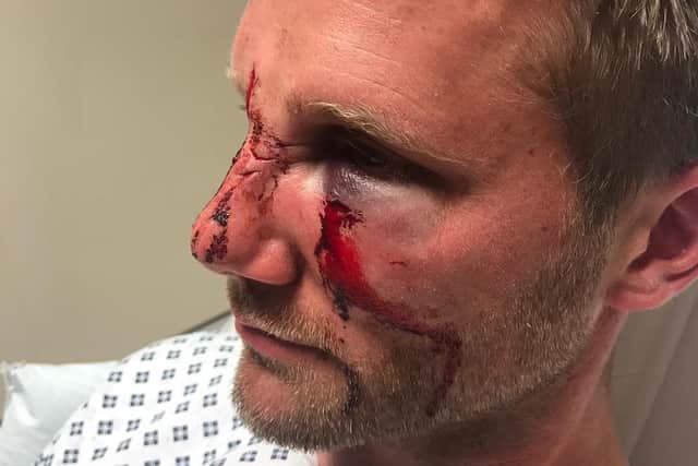 PC Dan Lumley was the victim of a nasty assault while responding to a 999 call.