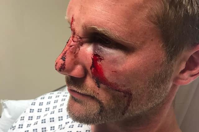 The injuries PC Dan Lumley sustained in the attack.