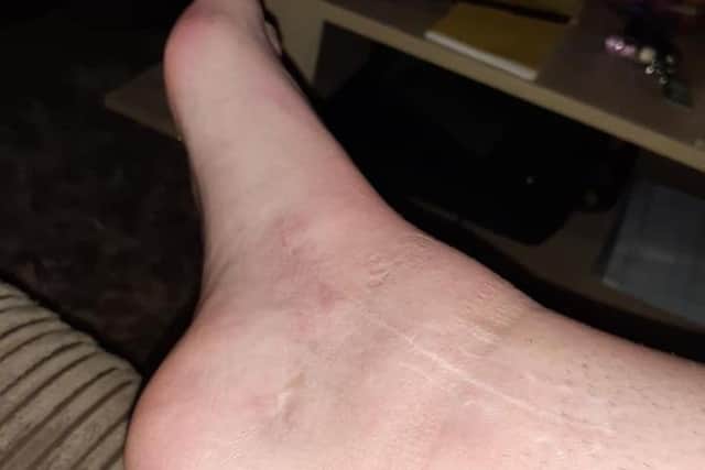 Victoria's ankle scar