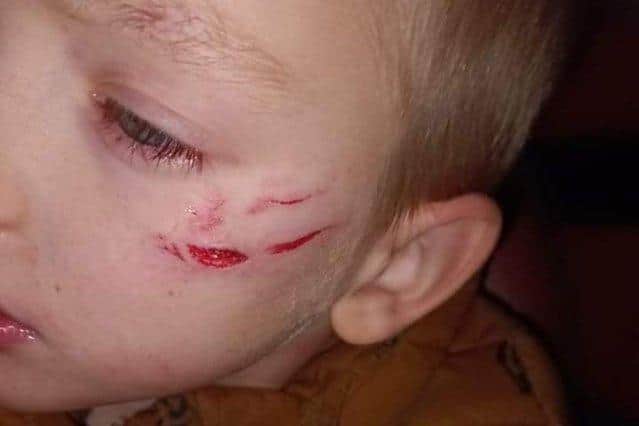 Chris Spencer shared this photo of his six-year-old son Reaf's injuries after the youngster was attacked by a dog in Concord Park, Sheffield