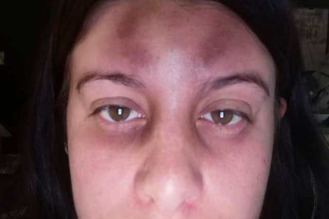 Daniella Parker's facial injuries after the attack by the father of her two children
