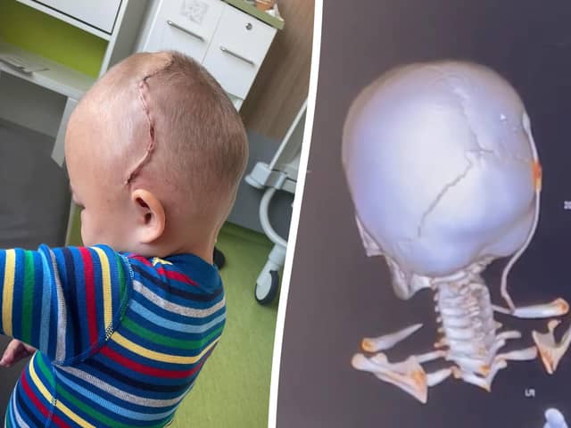 Beau Harrison was diagnosed with craniosynostosis when he was just 18 months old.