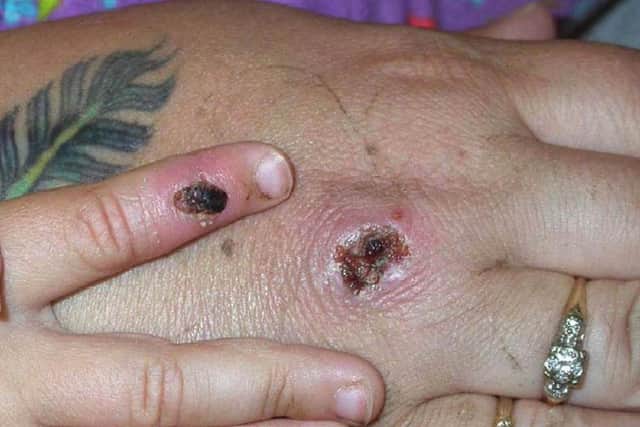 Monkeypox rashes turned to scabs. (Pic credit: CDC / Getty Images)