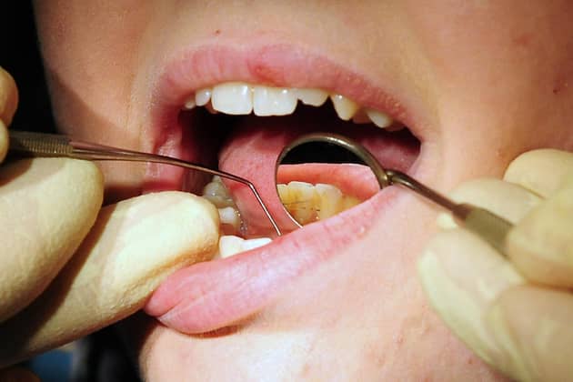 A dentist at work. NHS dentistry finds itself in a crisis. PIC: Rui Vieira/PA Wire