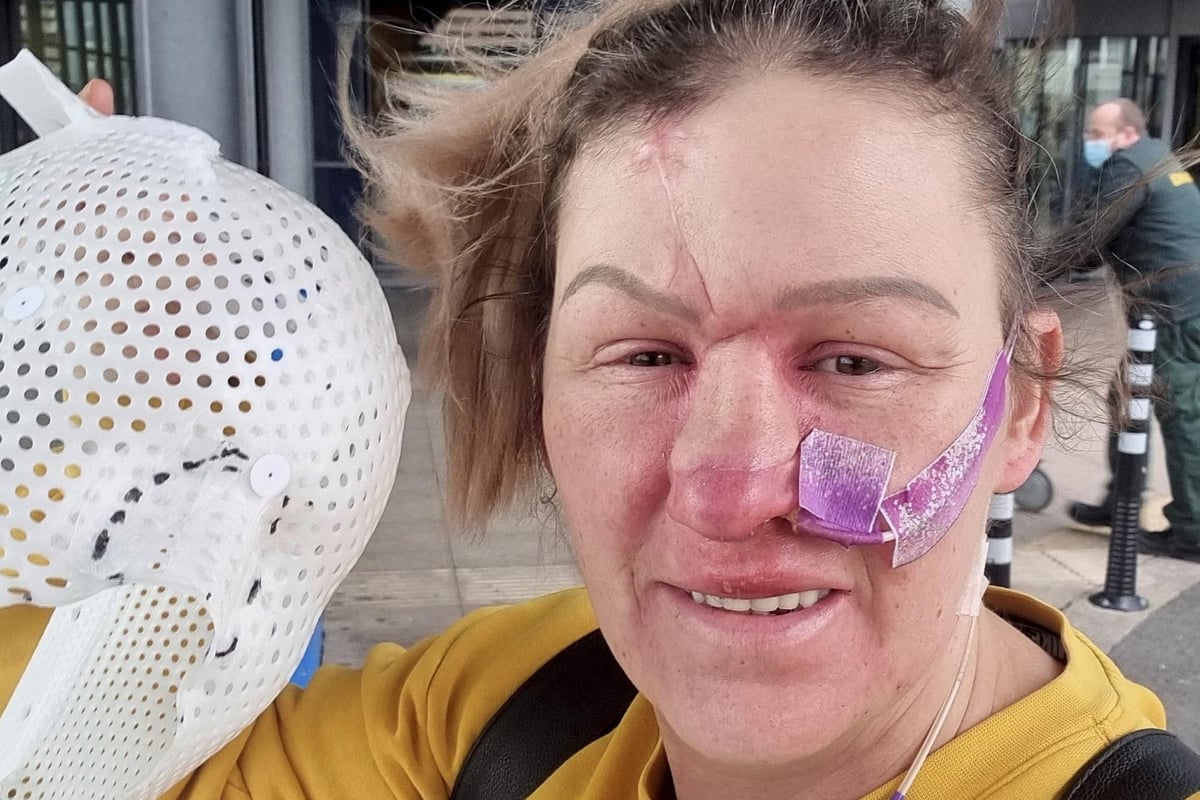 'I looked like a monster' - Woman has nose reconstructed from rib after cancer diagnosis