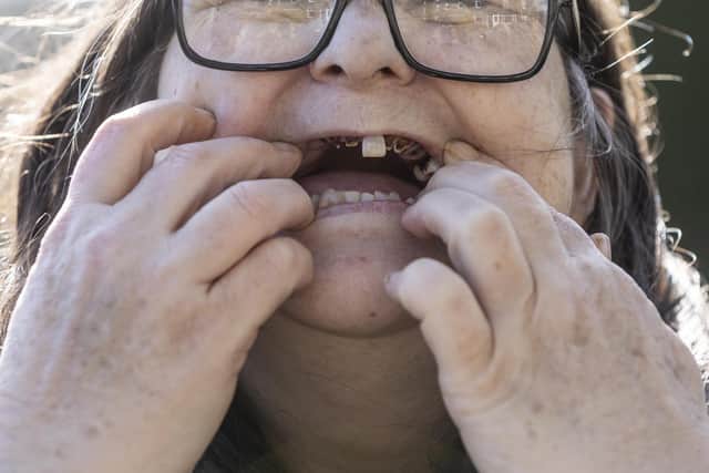 Mandy was forced onto antidepressants when she became suicidal after losing 12 top gnashers and one bottom - leaving her looking "like a drug addict".
