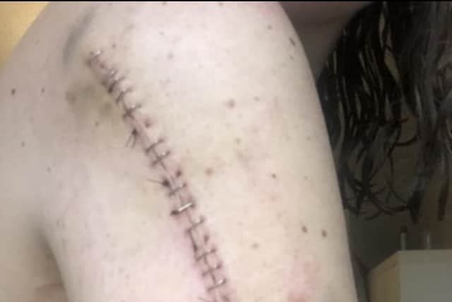 Megan's arm after the operation