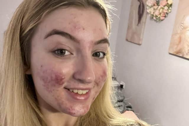 Eva Grant with no makeup, showing her acne