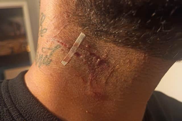 Farzad Hosseinpour's neck after a near deadly dog attack, in which his neighbours' Cane Corso narrowly miss his carotid artery.