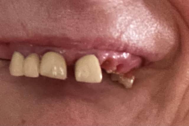 Audra said she was “scared to leave the house” and was unable to chew properly as she was left with only a couple of teeth in her top jaw.
