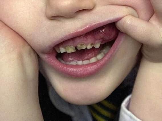 Nearly 38 per cent of five-year-olds in Hull have tooth decay