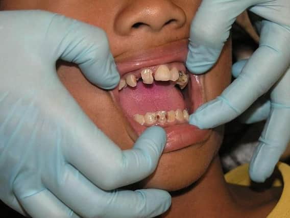 Around 38 per cent of five-year-olds in Hull suffer from tooth decay