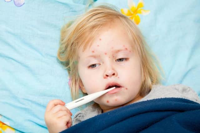 Measles.  PA Photo/thinkstockphotos