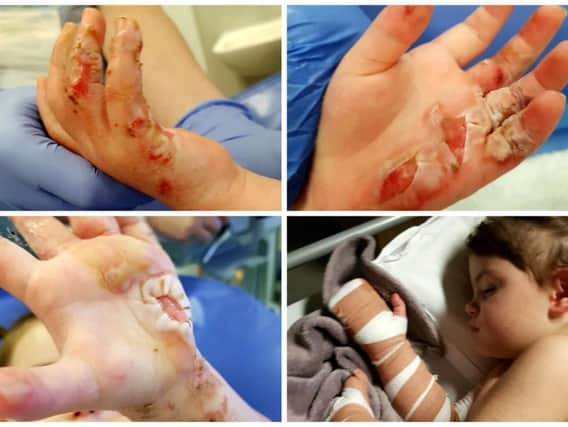 These horrific pictures show the third-degree burns suffered by a two-year-old girl after she tried to rescue her twin's teddy bear from catching fire. PICS: SWNS