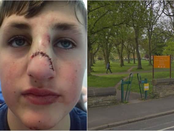 The 13-year-old boy had his face smashed with a log