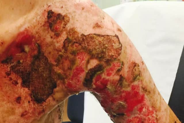The extent of the man's injuries after a deep fat fryer scalding