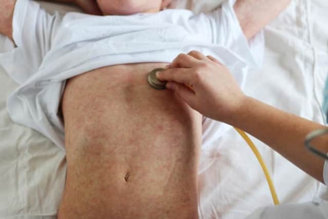 Cases of measles are on the rise across the UK (Photo: Shutterstock)