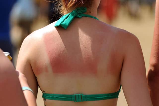After a weekend in the sun many people will be feeling sore and sunburned today
