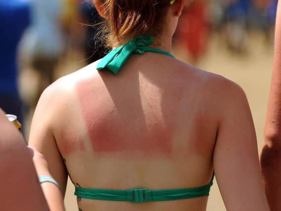 After a sunny Easter bank holiday, many people will be feeling a bit sore and sunburned today