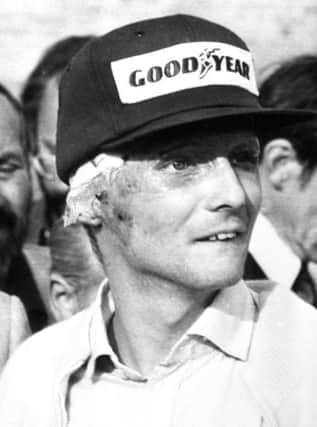 Niki Lauda after his skin grafting operation following his crash in the 1976 German Grand Prix at the Nurburgring.