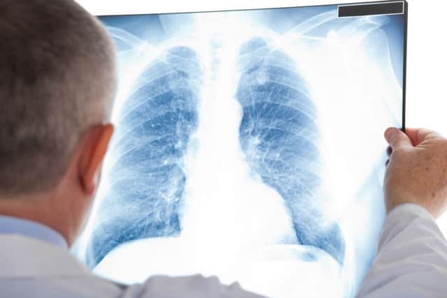 Lung cancer treatment in the UK lags behind other high-income countries.