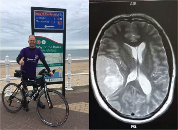 Surgeons took more than seven hours to remove a tumour the size of an apple from Chris Bexon's skull