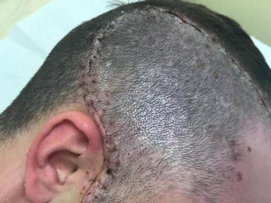 The head injury Kieran Lofthouse sustained during the attack.