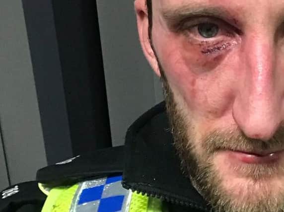 This North Yorkshire Police officer sustained a fractured cheekbone after he was attacked while on duty.