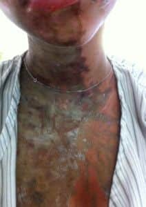 A family photo of one of the two British teenagers attacked with acid on Zanzibar.