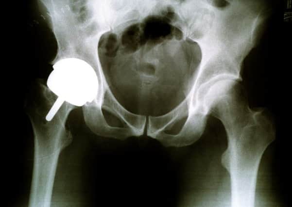 X Ray of a replacement hip