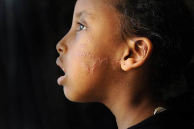 Layla Musse, six, with the scars following the attack by a Staffordshire bull terrier owned by Sharman O'Flaherty, below