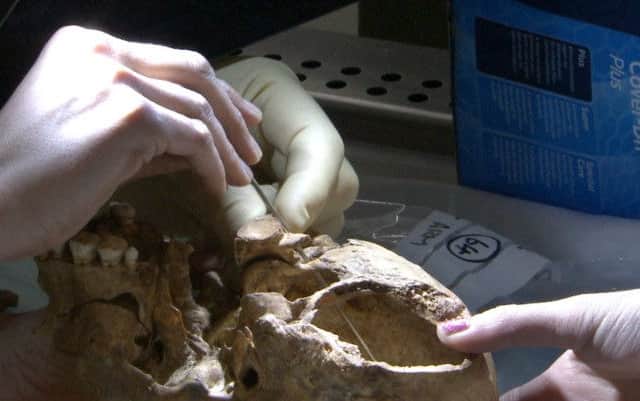 Leicester University photo of the wounds on the skull of King Richard III that caused his death.