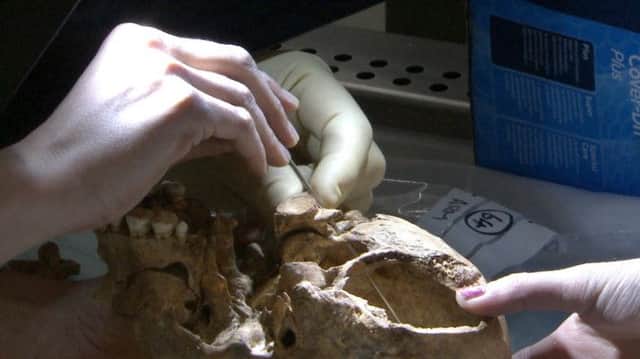 Leicester University photo of the wounds on the skull of King Richard III that caused his death.